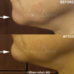 Chin augmentation and enhancement with filler injection (Voluma, Bellafill, Radiesse)