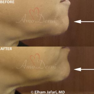 Chin augmentation and enhancement with filler injection (Voluma, Bellafill, Radiesse)