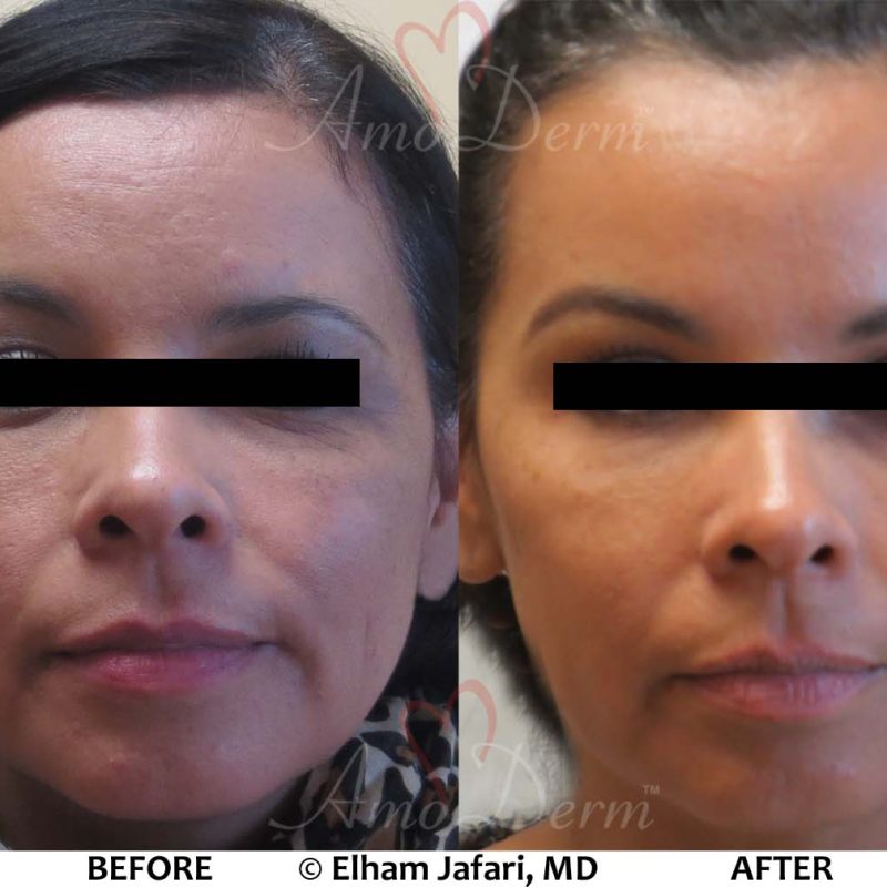 Dark Circles Under Eyes