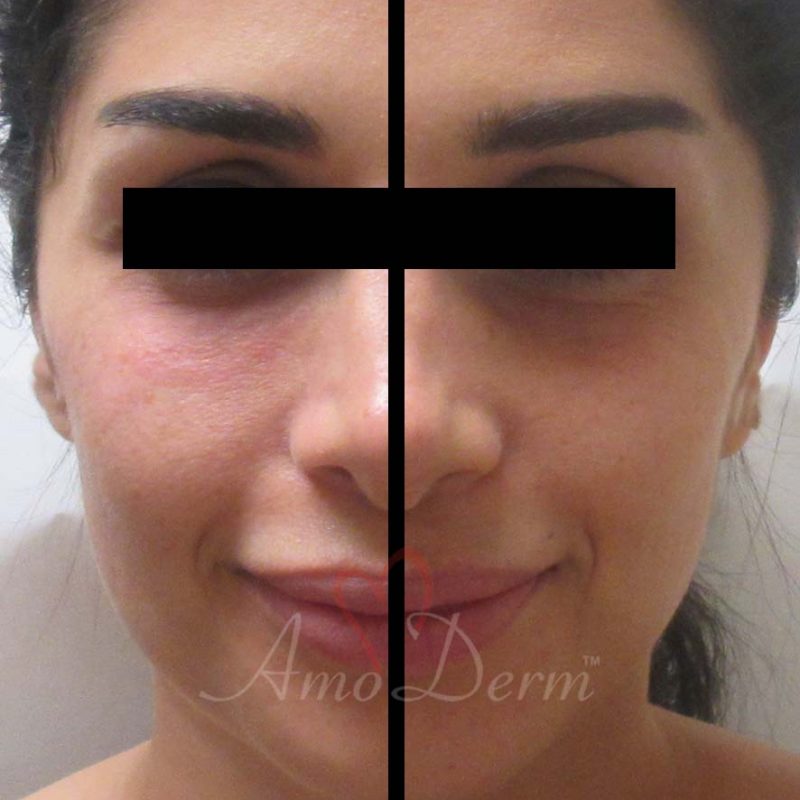 Dark Circles Under Eyes