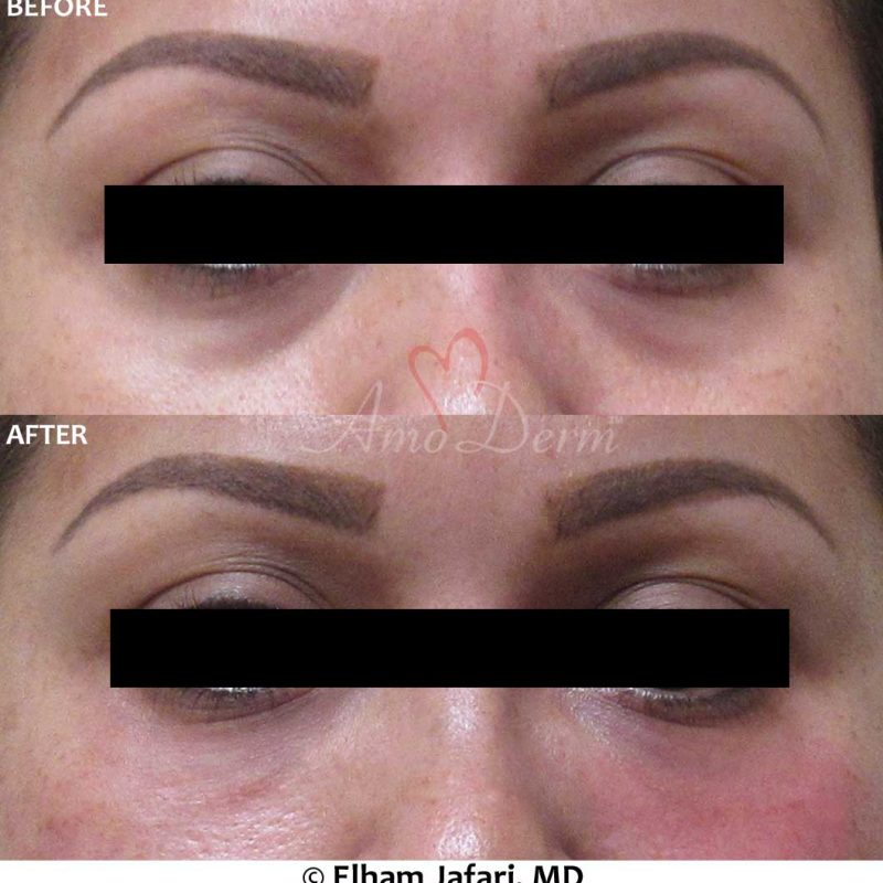Dark Circles Under Eyes
