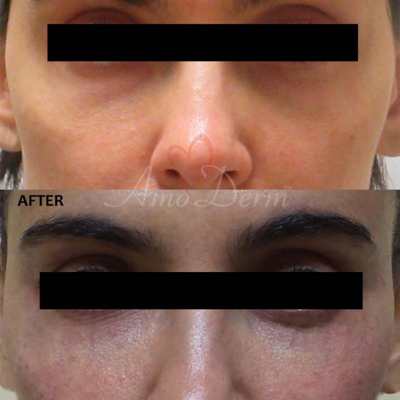 Dark Circles Under Eyes