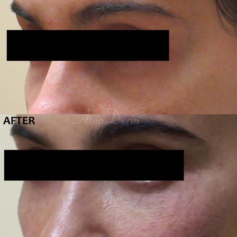 Dark Circles Under Eyes