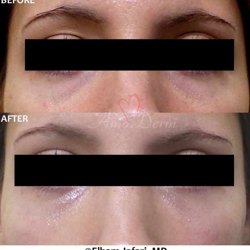 Dark Circles Under Eyes