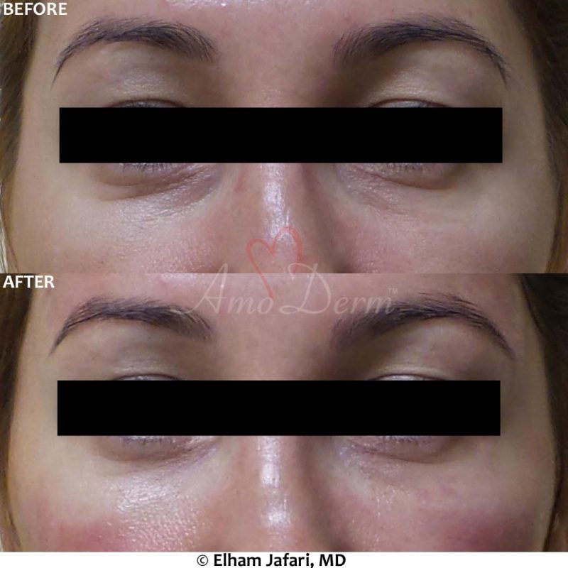 Dark Circles Under Eyes
