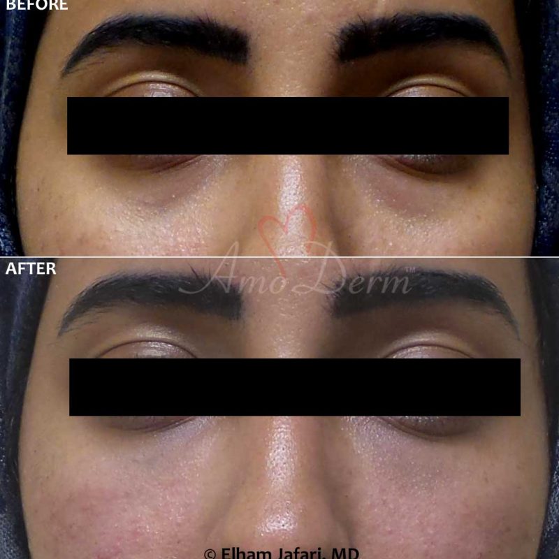 Dark Circles Under Eyes