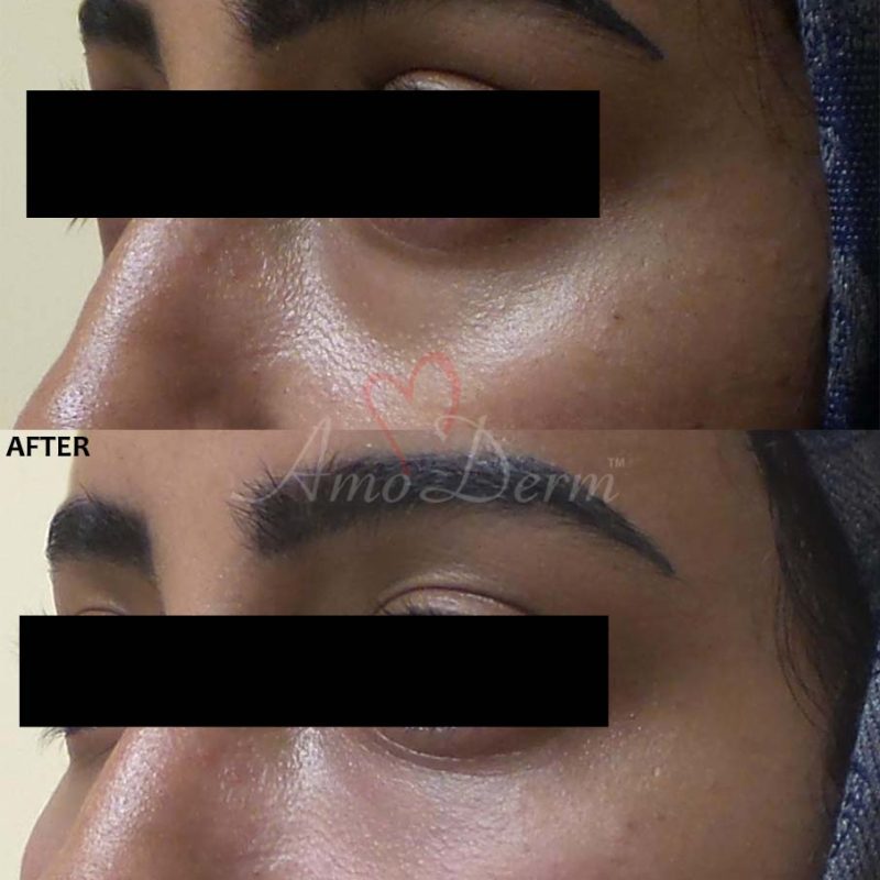Dark Circles Under Eyes