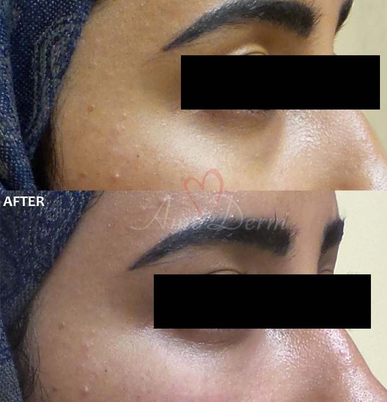 Dark Circles Under Eyes