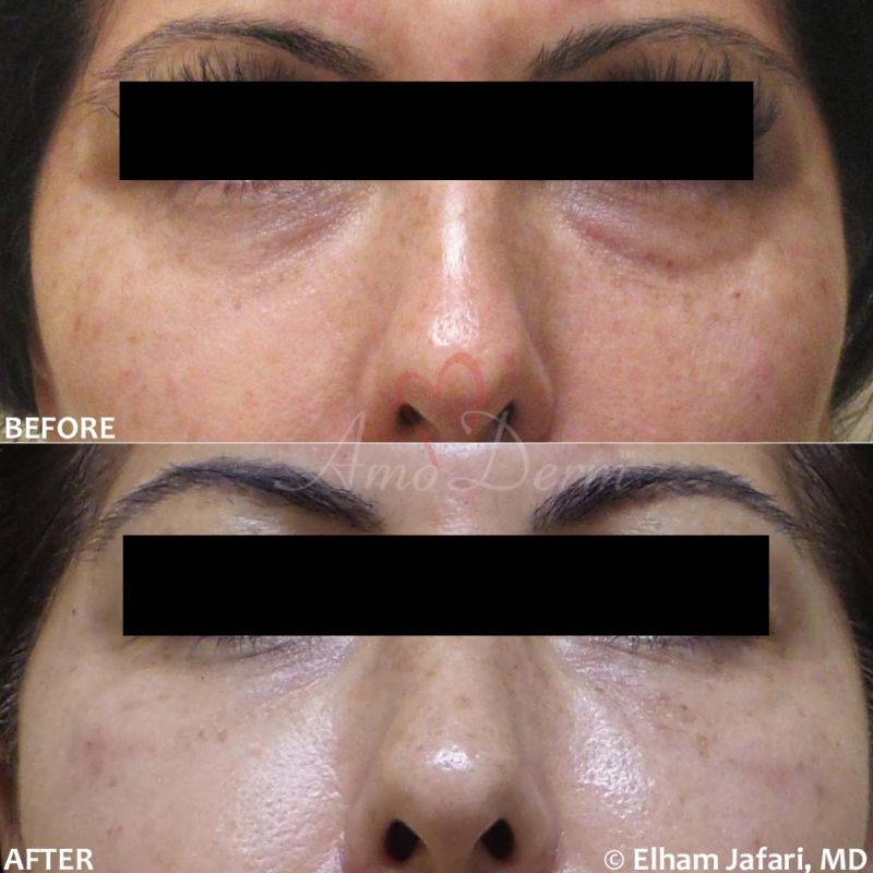 Dark Circles Under Eyes