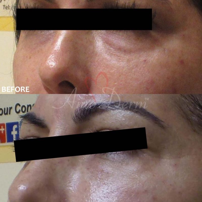 Dark Circles Under Eyes