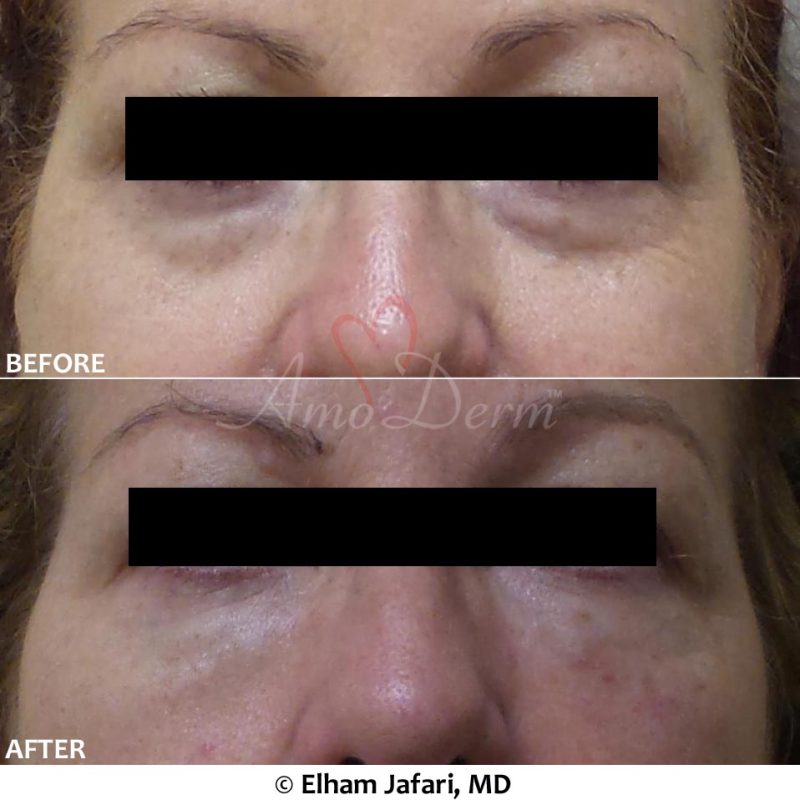 Dark Circles Under Eyes