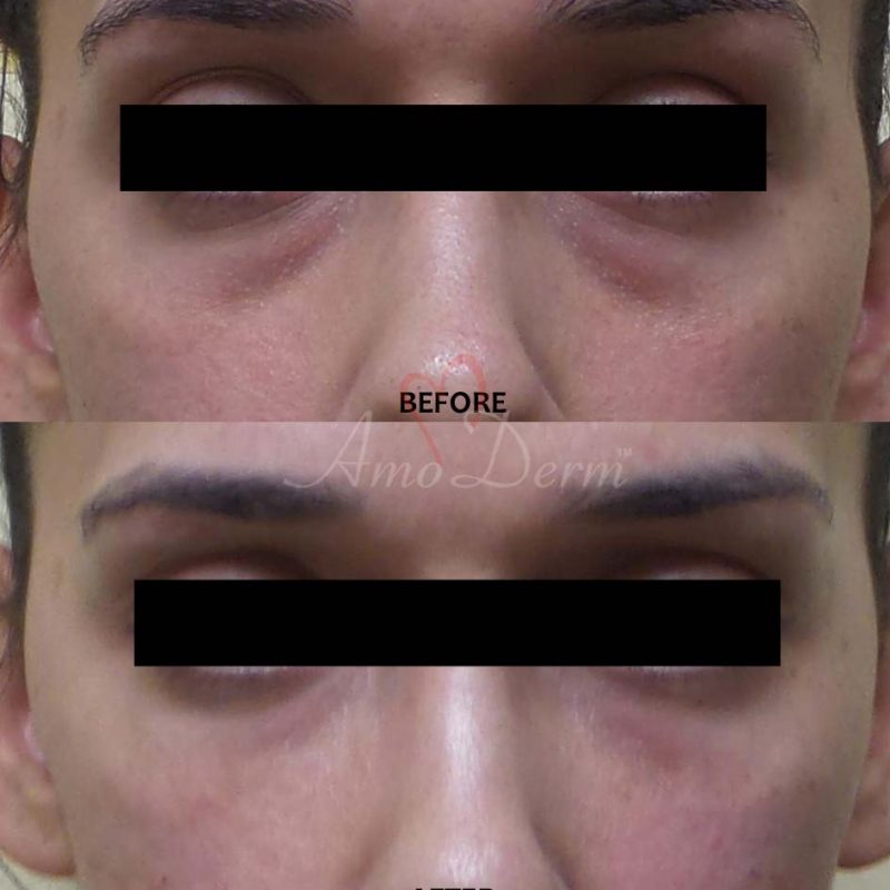 Dark Circles Under Eyes