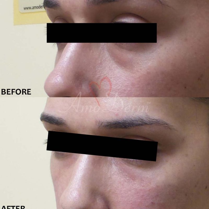 Dark Circles Under Eyes