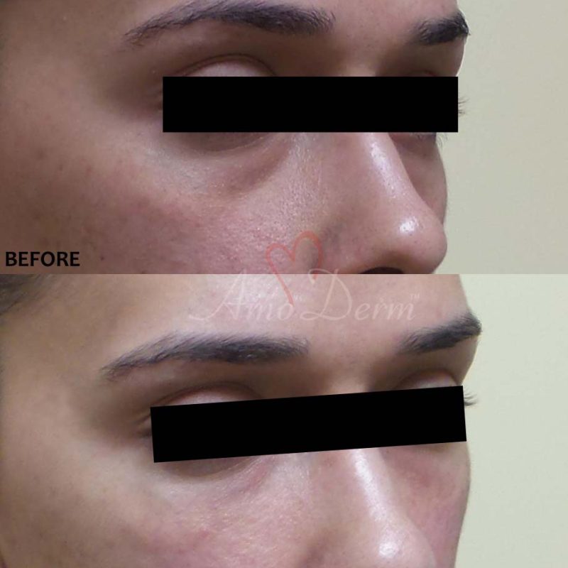 Dark Circles Under Eyes