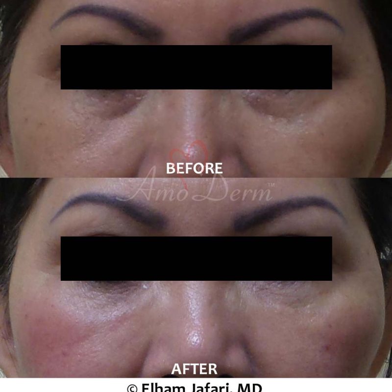 Dark Circles Under Eyes