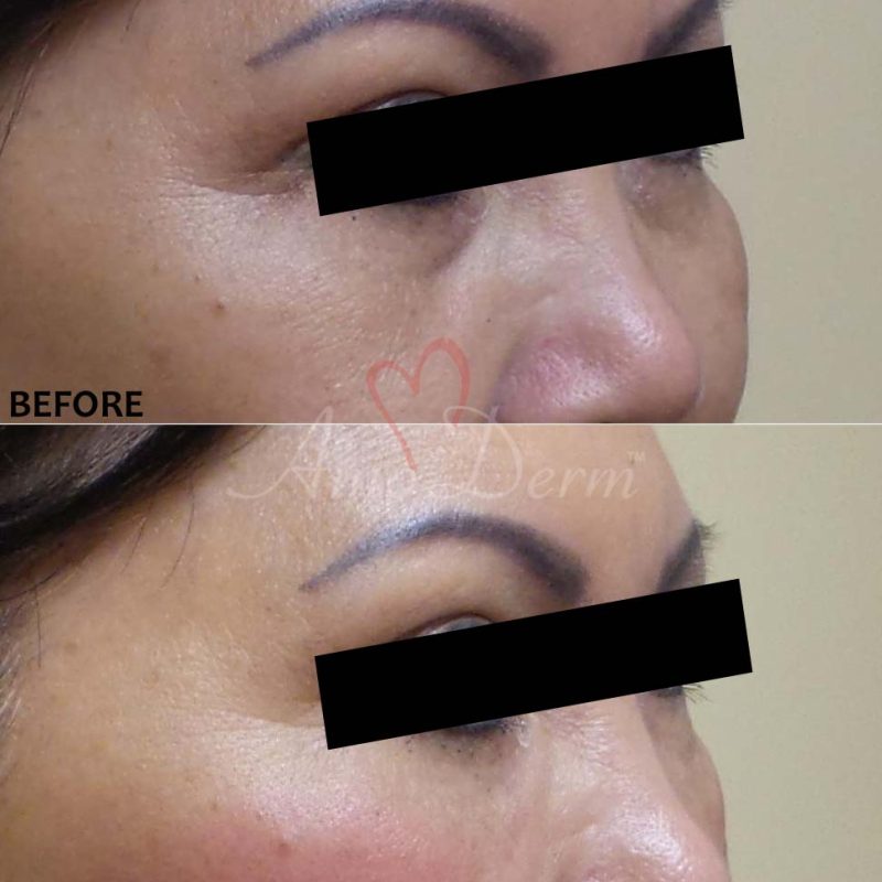 Dark Circles Under Eyes