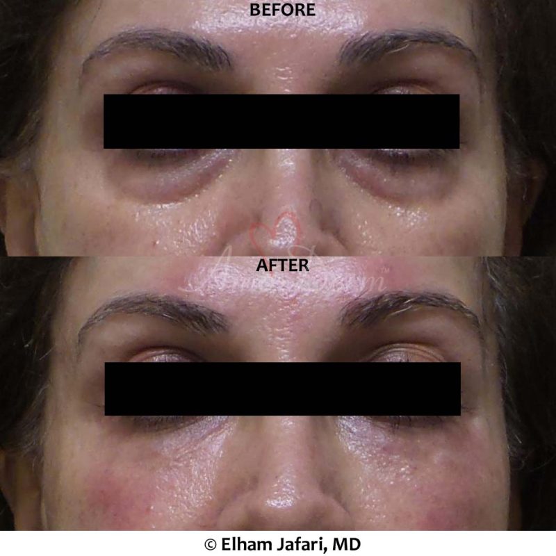 Dark Circles Under Eyes
