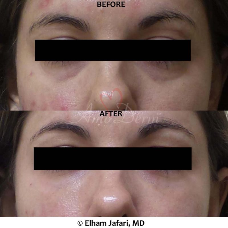Dark Circles Under Eyes