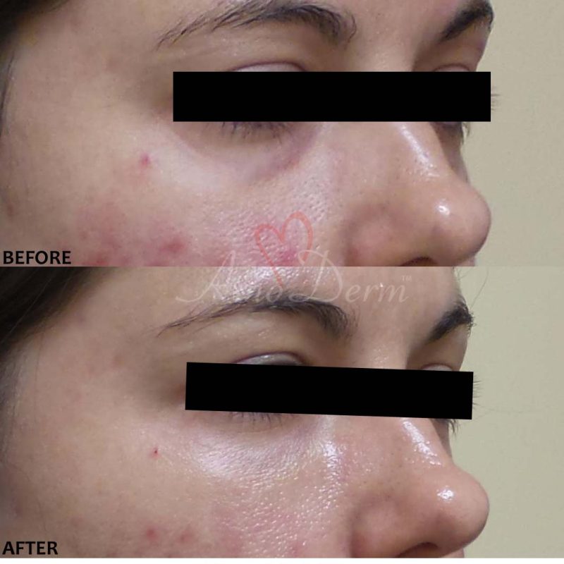 Dark Circles Under Eyes