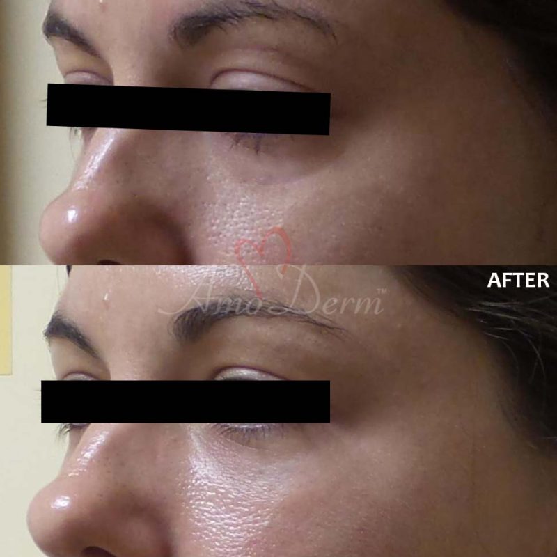 Dark Circles Under Eyes