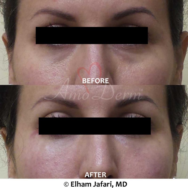 Dark Circles Under Eyes