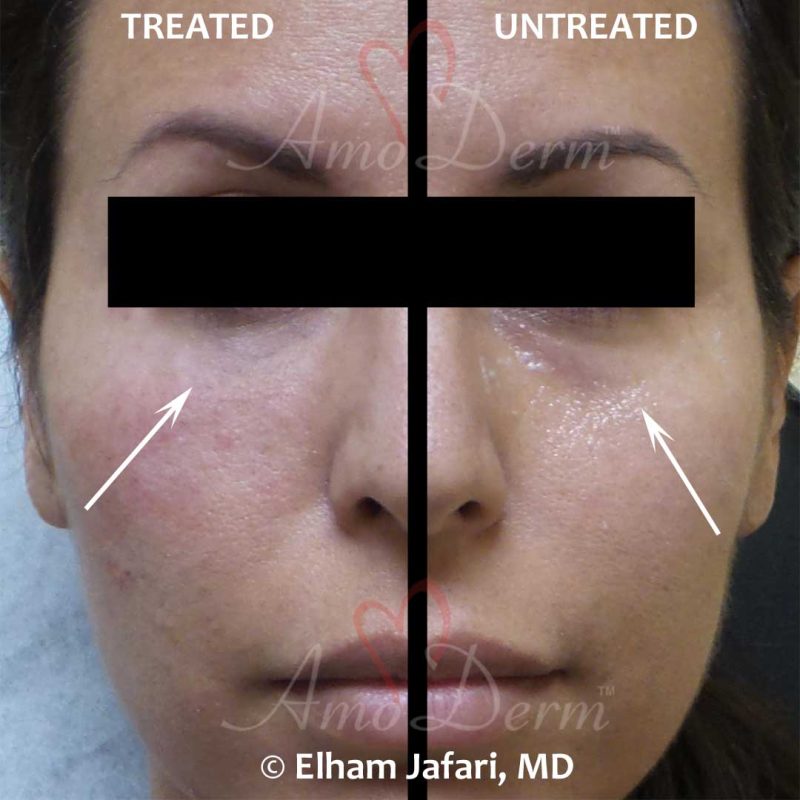 Dark Circles Under Eyes