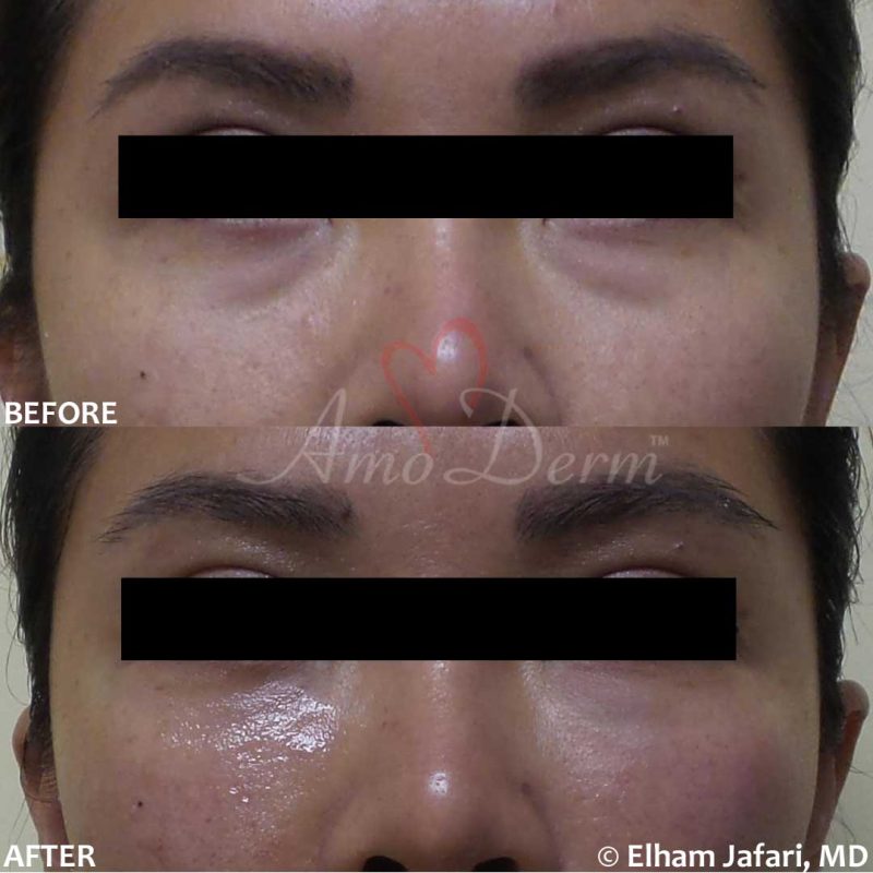 Dark Circles Under Eyes