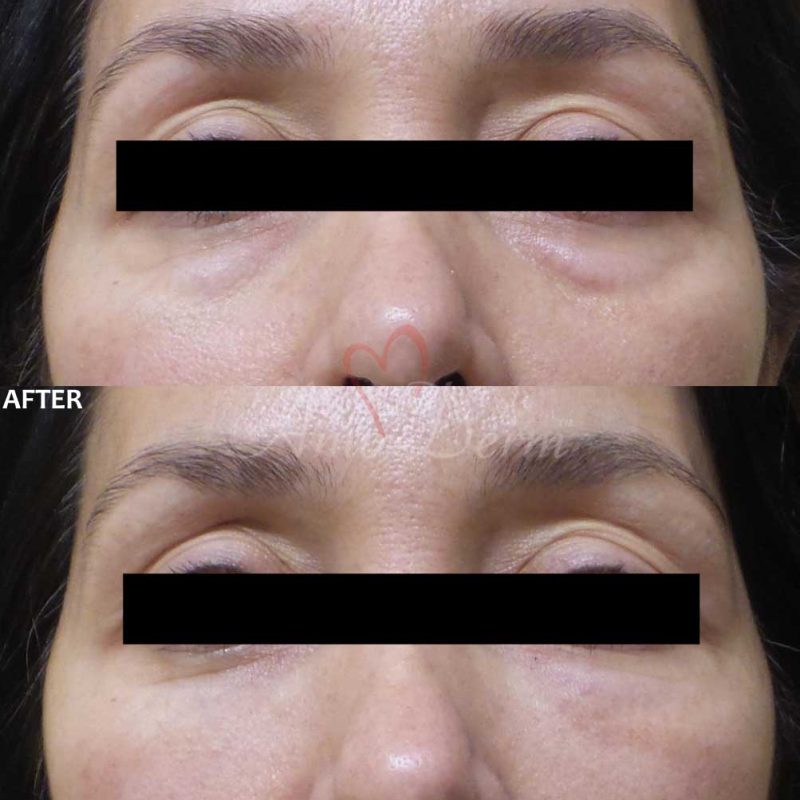 Dark Circles Under Eyes