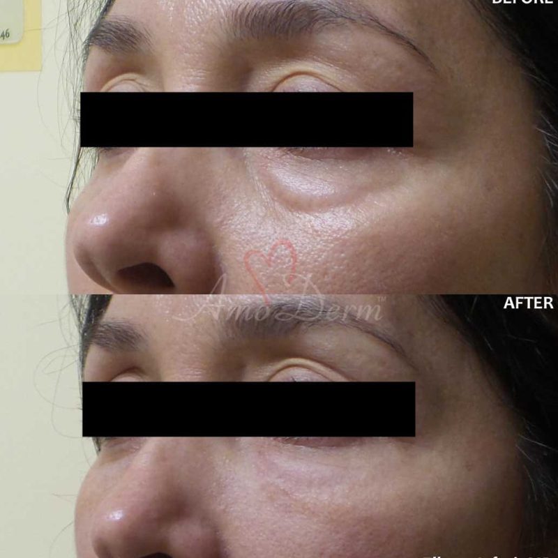 Dark Circles Under Eyes