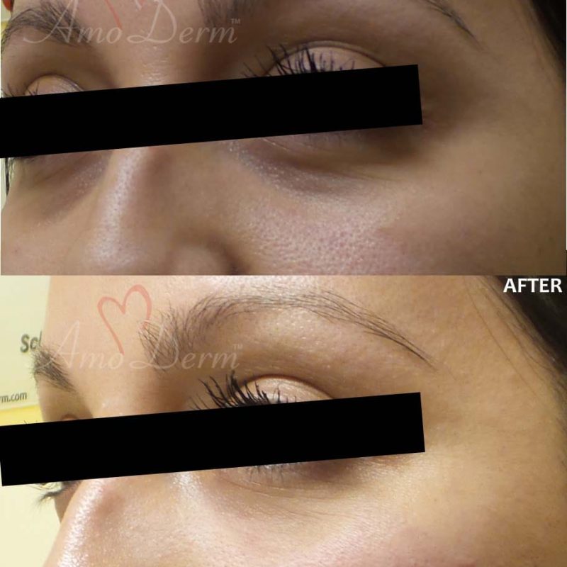 Dark Circles Under Eyes