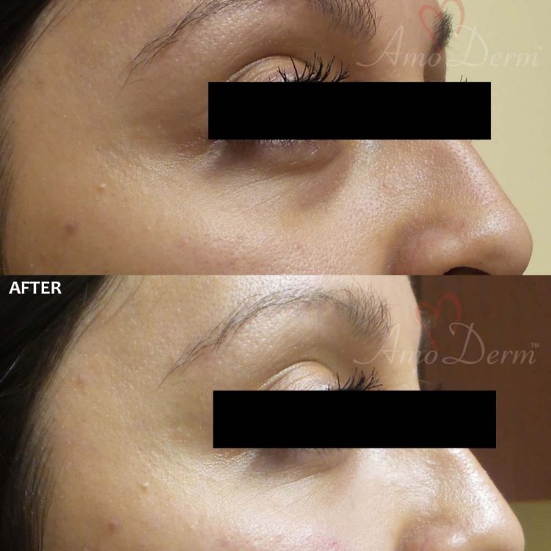 Dark Circles Under Eyes