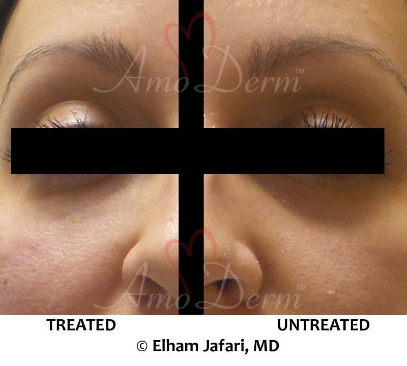 Dark Circles Under Eyes