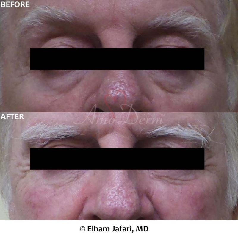 Dark Circles Under Eyes