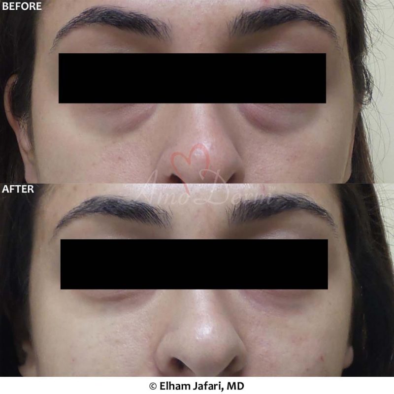 Dark Circles Under Eyes