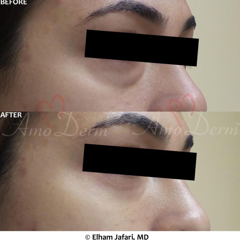 Dark Circles Under Eyes Cosmetic Treatments Before and After Pictures Dark Circles Under Eyes