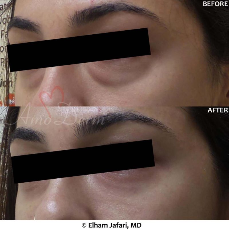 Dark Circles Under Eyes Cosmetic Treatments Before and After Pictures Dark Circles Under Eyes