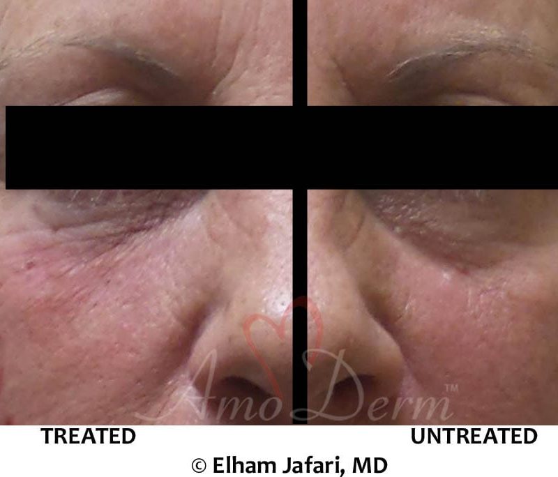Dark Circles Under Eyes Cosmetic Treatments Before and After Pictures Dark Circles Under Eyes