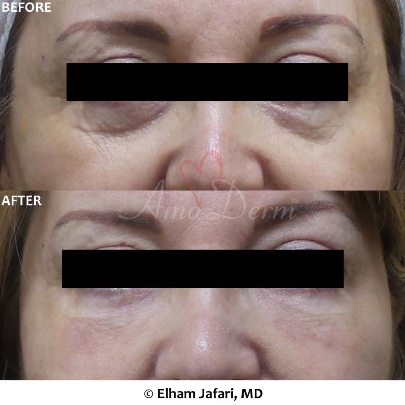 Dark Circles Under Eyes Cosmetic Treatments Before and After Pictures Dark Circles Under Eyes