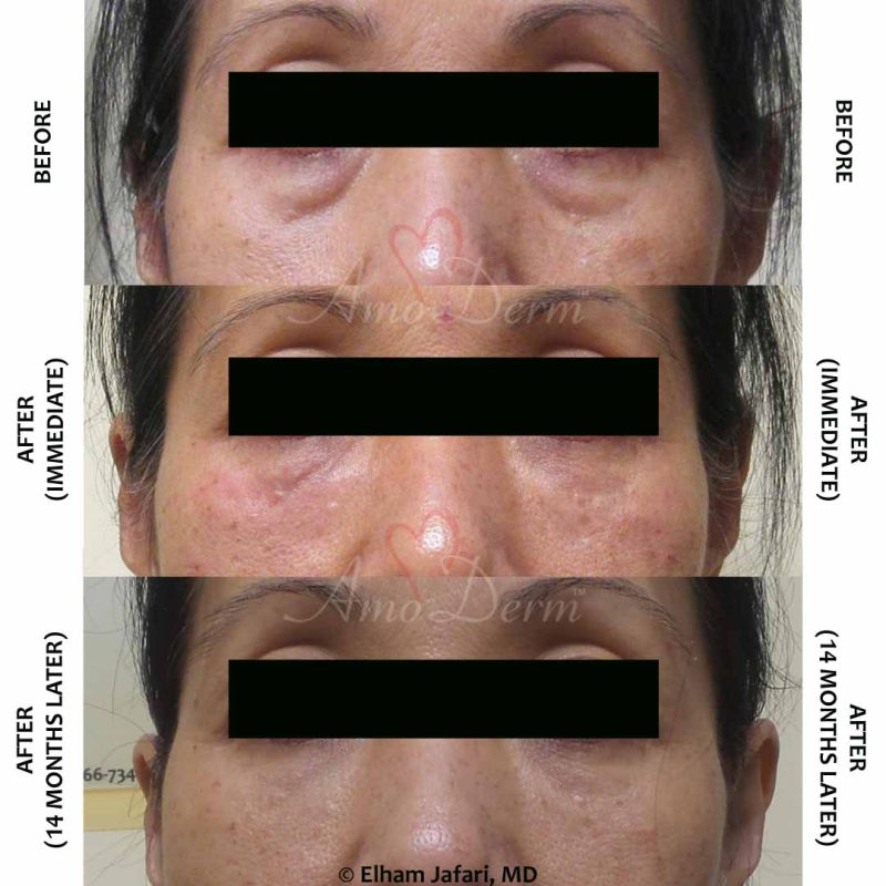 Dark Circles Under Eyes