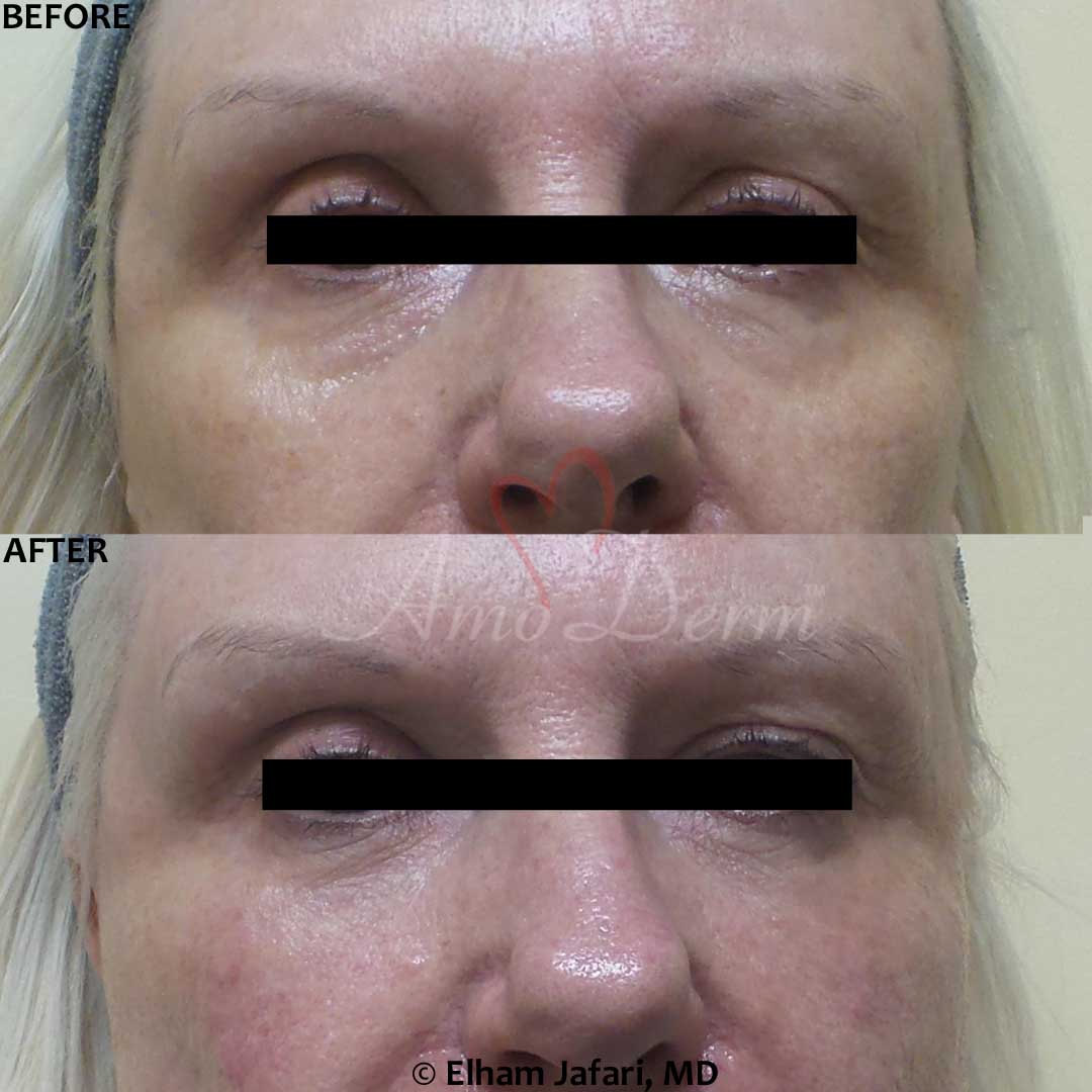 Treat dark circles & bags under eyes using fillers & lasers