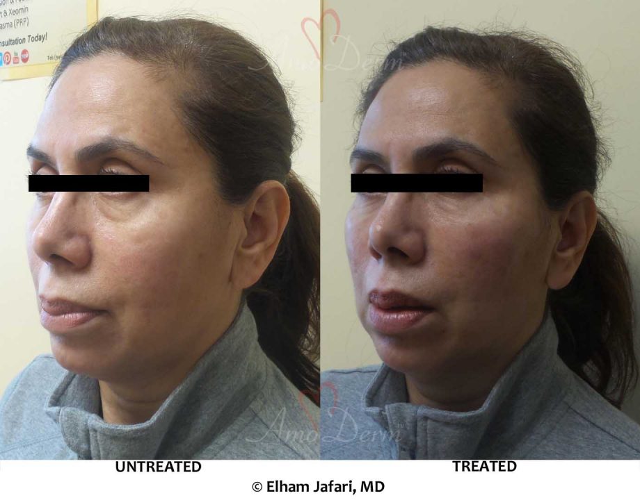 download under eyes treatment download under eyes treatment