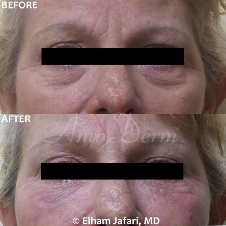 download dark circles under eyes treatment download dark circles under eyes treatment