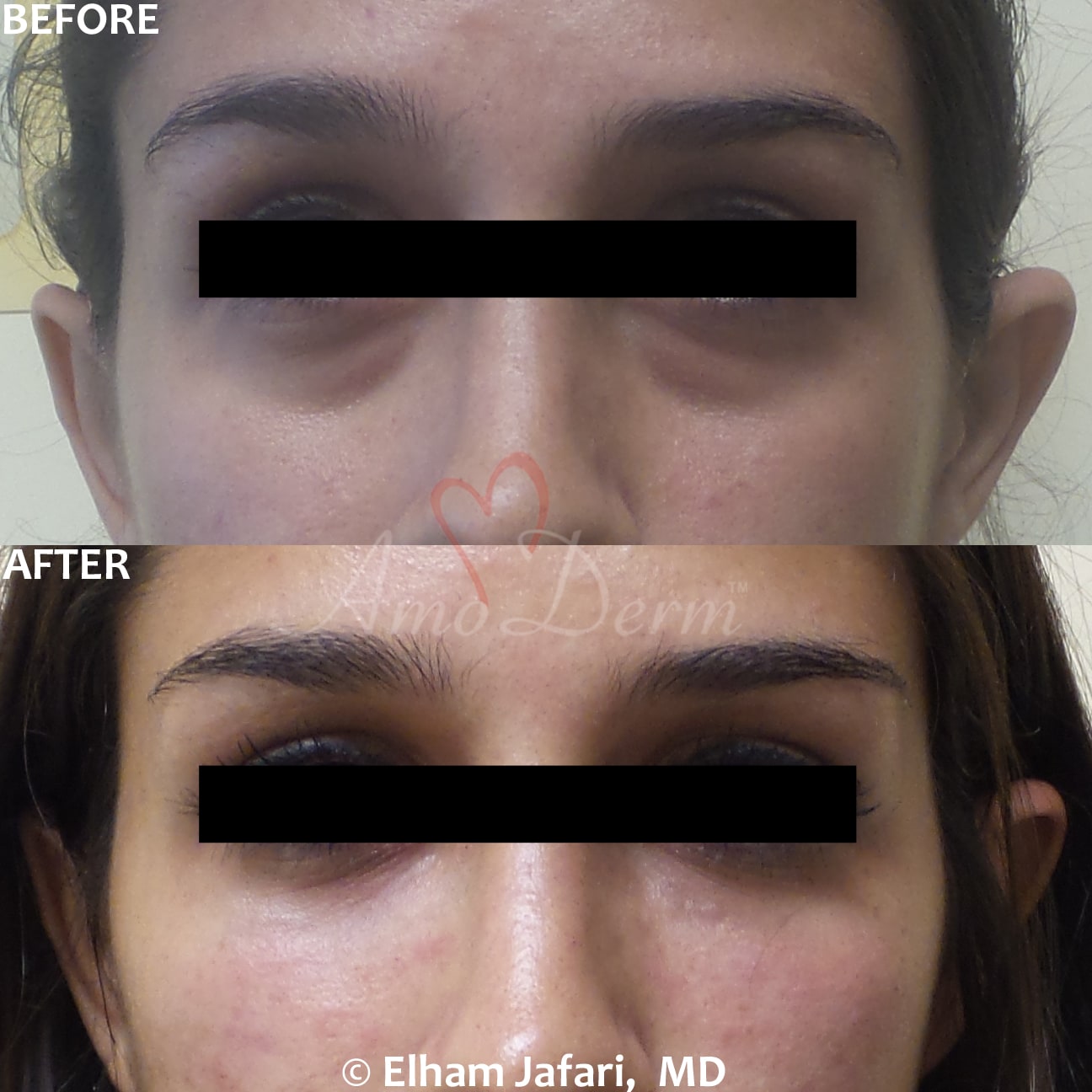Treat dark circles & bags under eyes using fillers & lasers