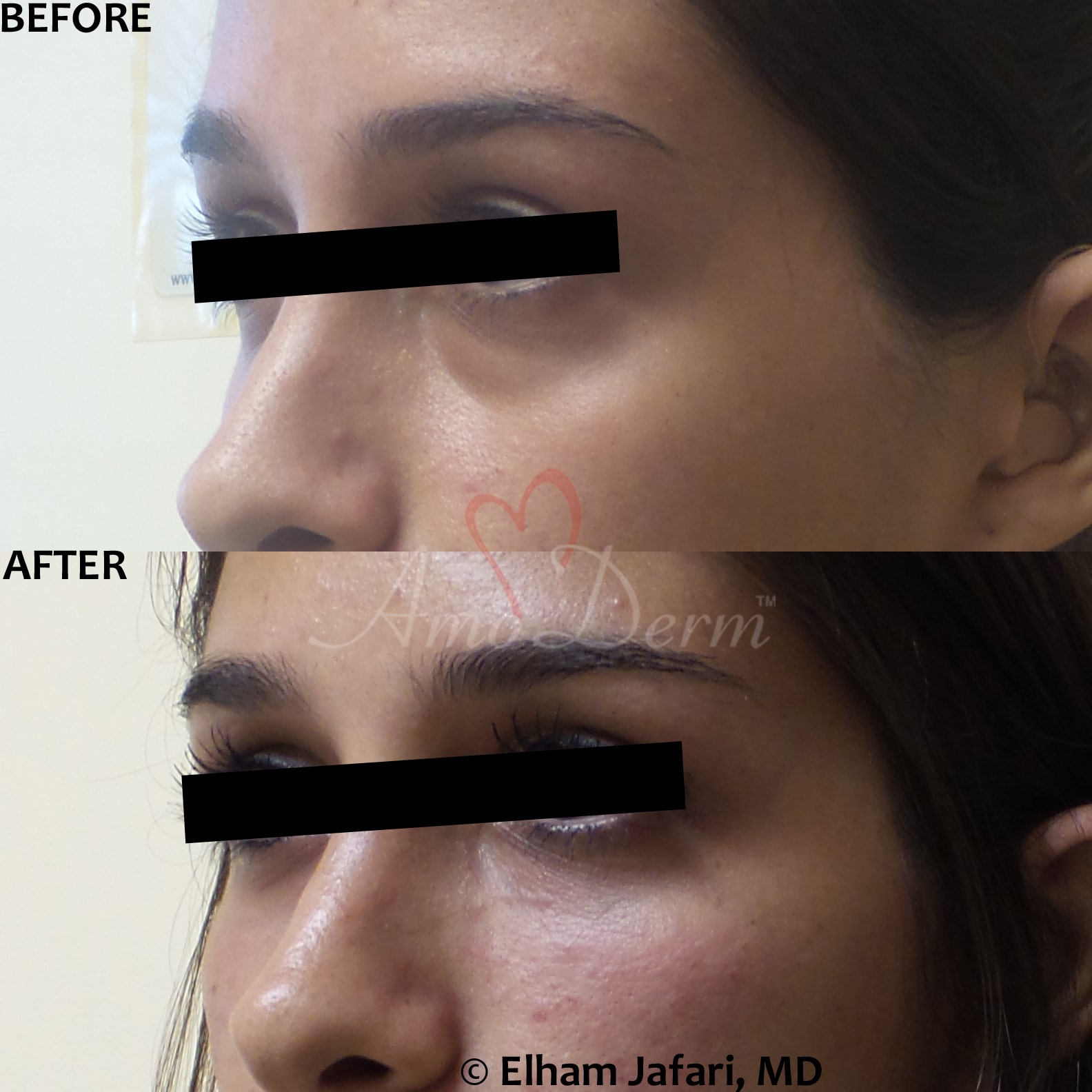 Treat dark circles & bags under eyes using fillers & lasers