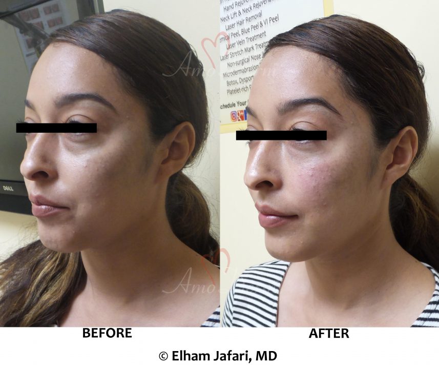 Cosmetic Surgery Bags Under Eyes Treatment IUCN Water