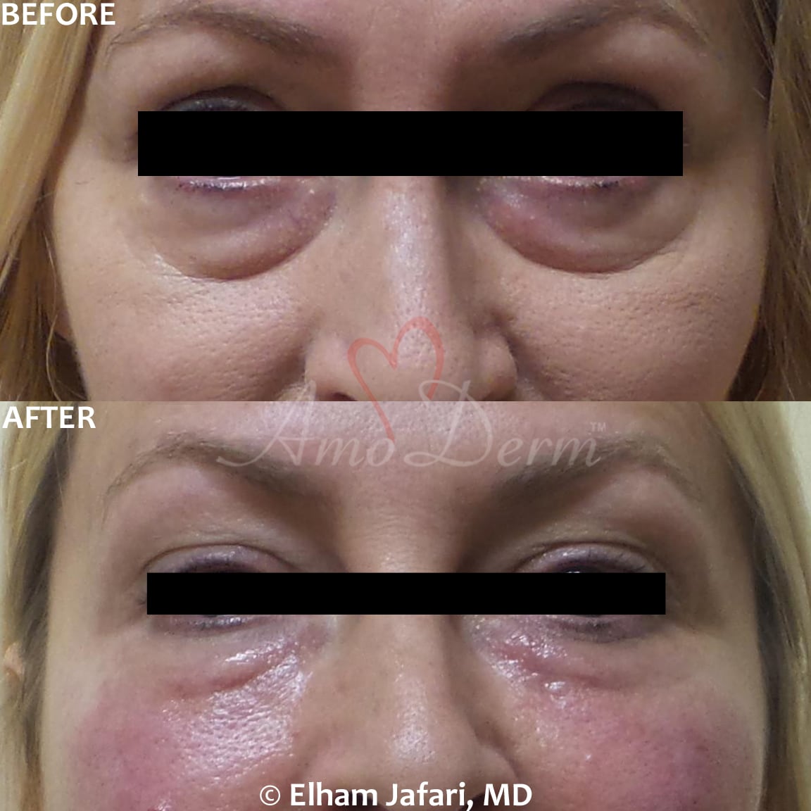 Treat dark circles & bags under eyes using fillers & lasers