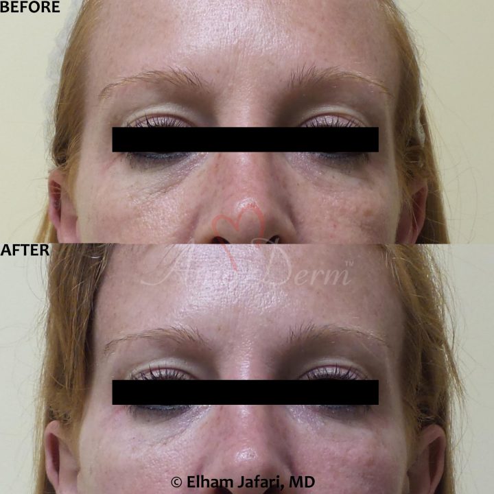 download under eyes treatment download under eyes treatment