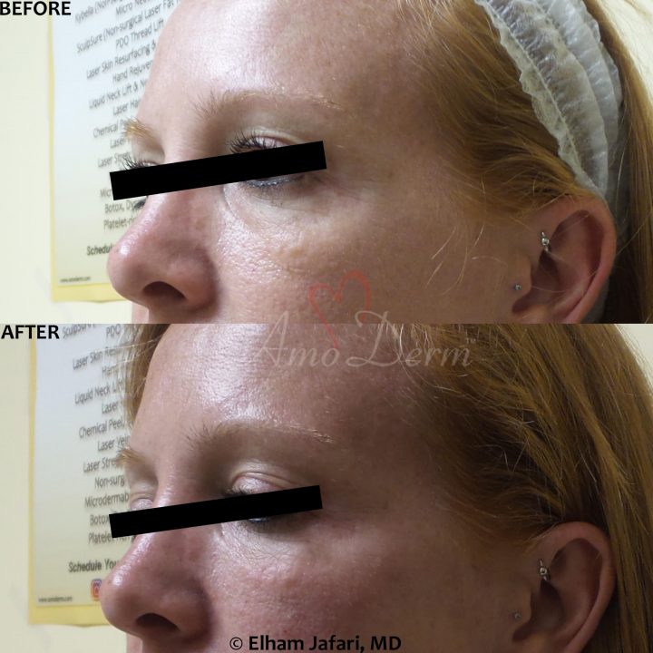 Treat dark circles & bags under eyes using fillers & lasers
