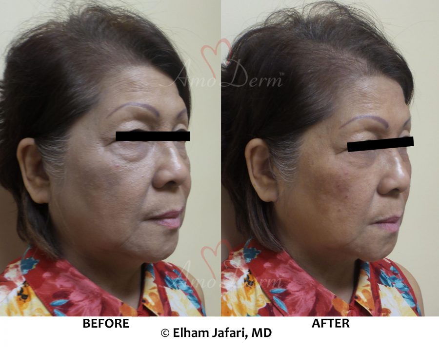 download dark circles under eyes treatment download dark circles under eyes treatment