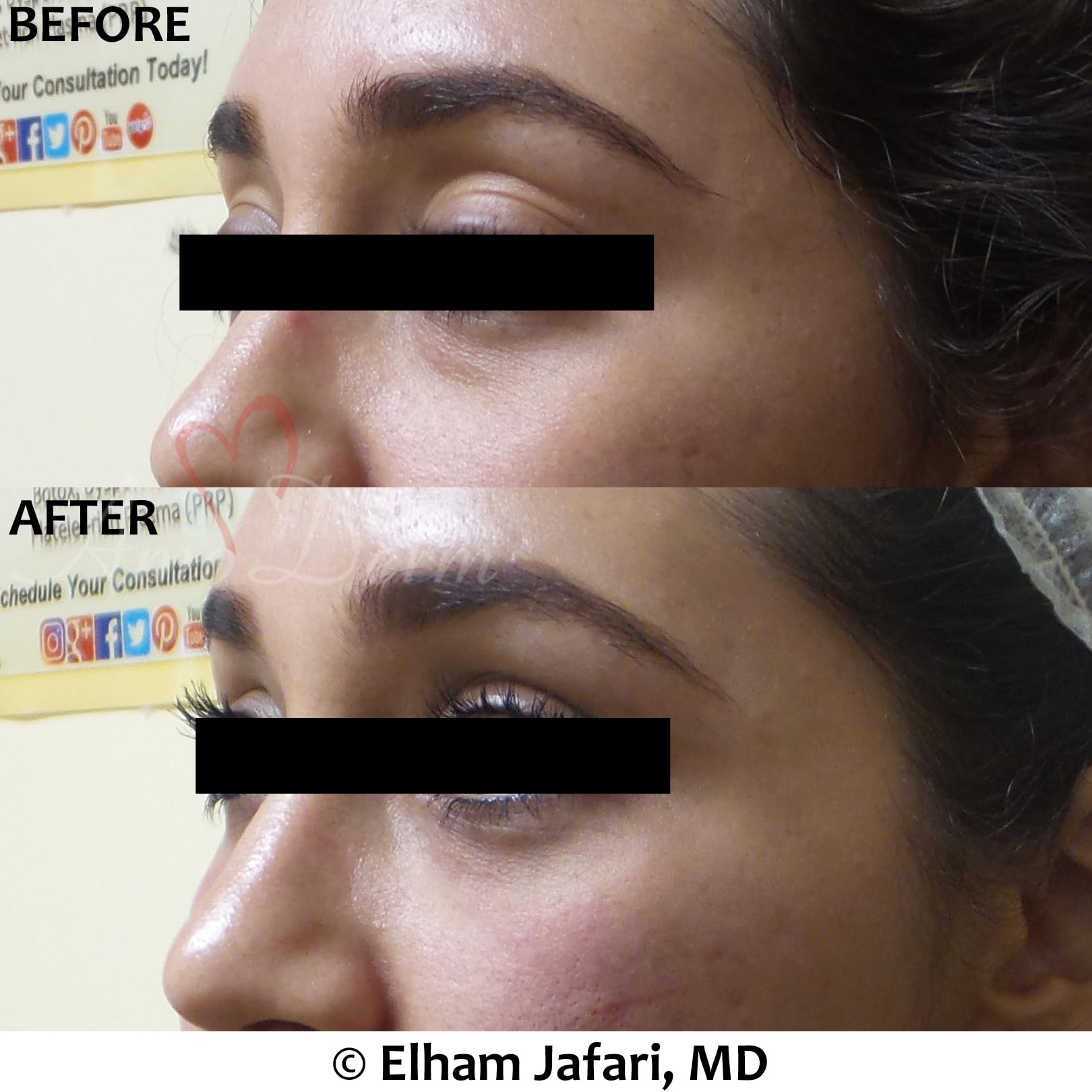Treat dark circles & bags under eyes using fillers & lasers